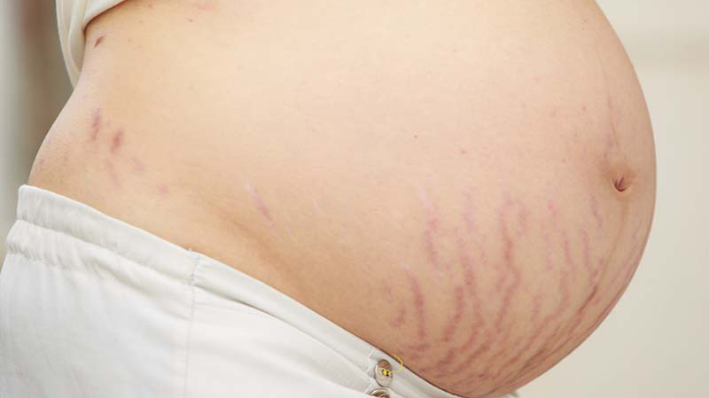 Nguyên nhân, các giai đoạn của rạn da khi mang thai và cách phòng ngừa