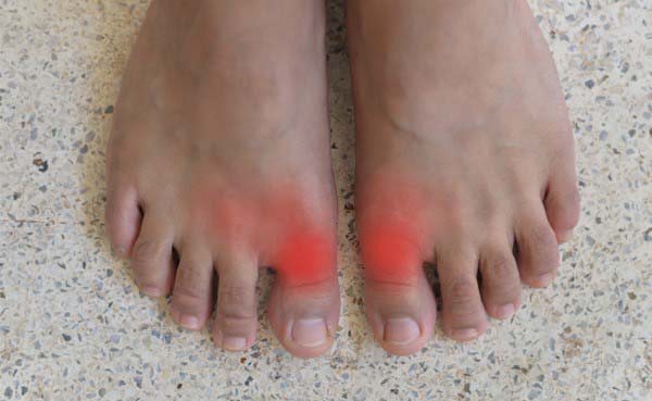 Thoái hóa khớp ngón chân cái: Triệu chứng, nguyên nhân và cách điều trị