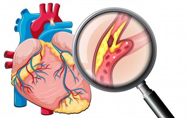 Xơ vữa động mạch: Ai có nguy cơ bị mắc bệnh và phòng ngừa ra sao?